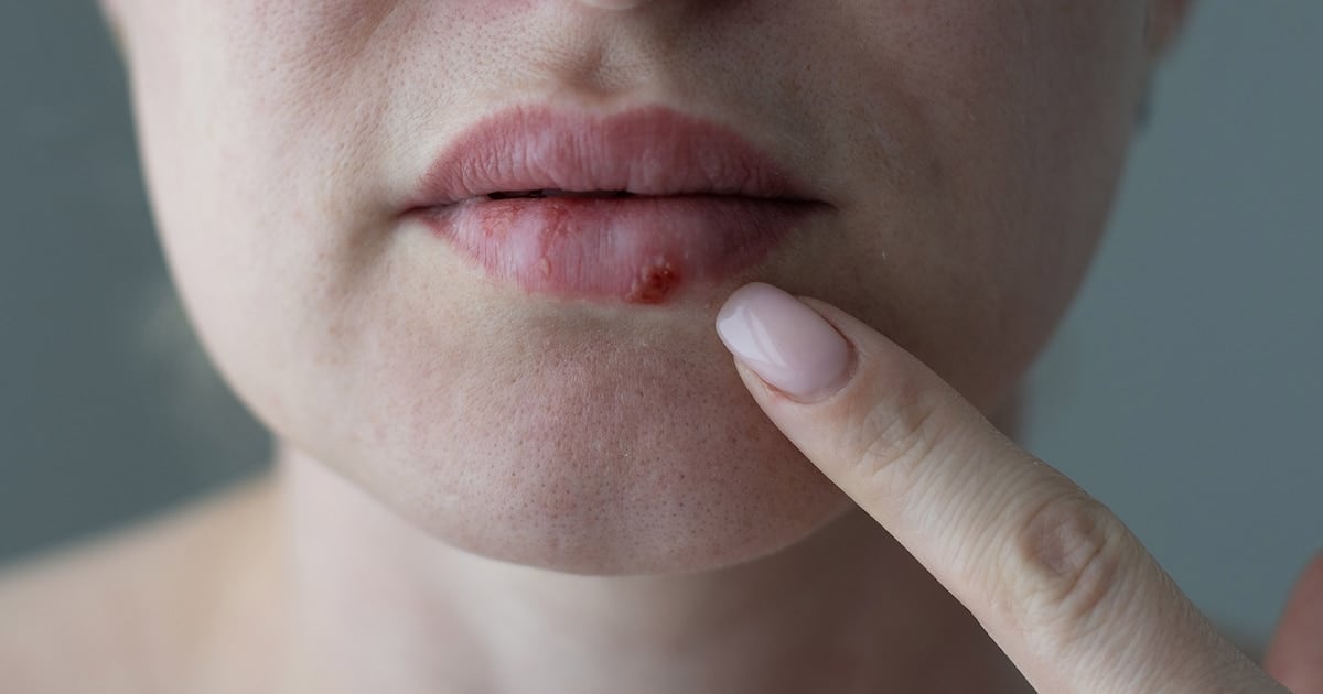 La FDA aprobó el pritelivir, el primer antiviral oral nuevo en casi treinta años para el herpes resistente en pacientes inmunocomprometidos