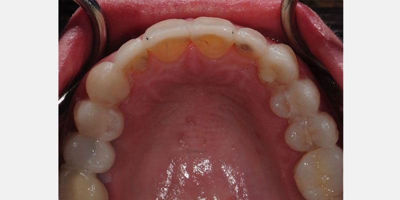 Carillas dentales: la filtración silenciosa que puede poner en riesgo el diente